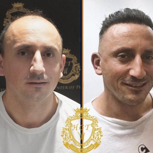 hair transplant before and after photos in turkey