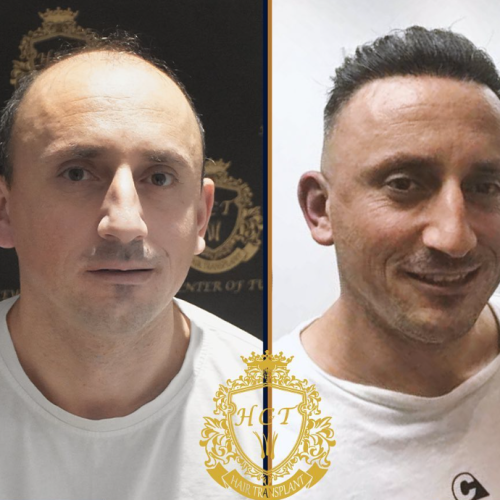 hair transplant before and after photos in turkey