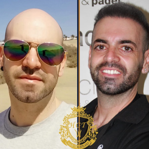 hair transplant before and after photos in turkey