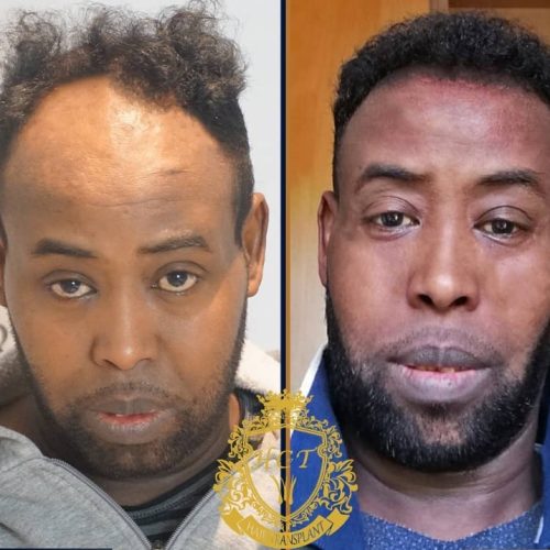 hair transplant before and after photos in turkey