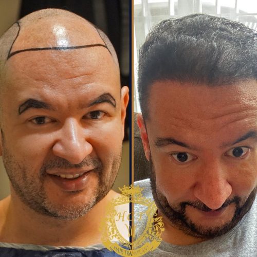 hair transplant before and after photos in turkey