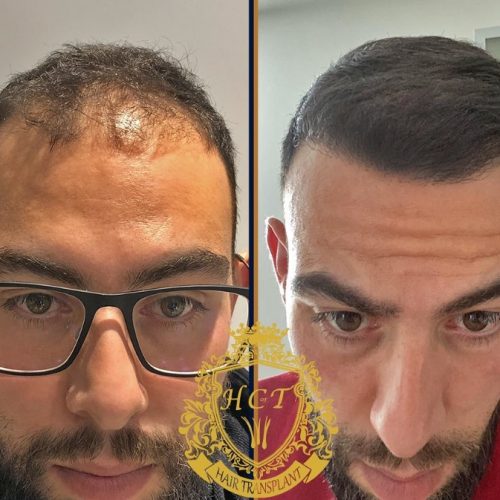 hair transplant before and after photos in turkey