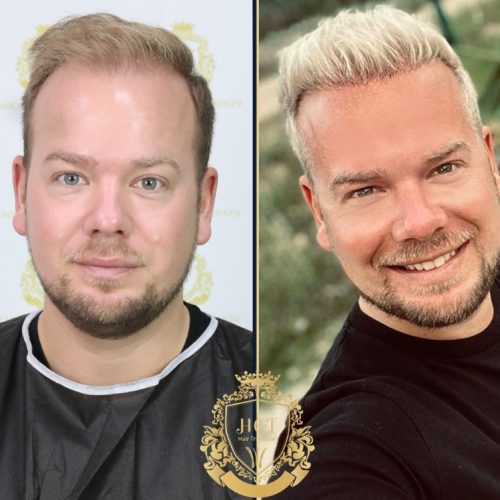 hair transplant before and after photos in turkey