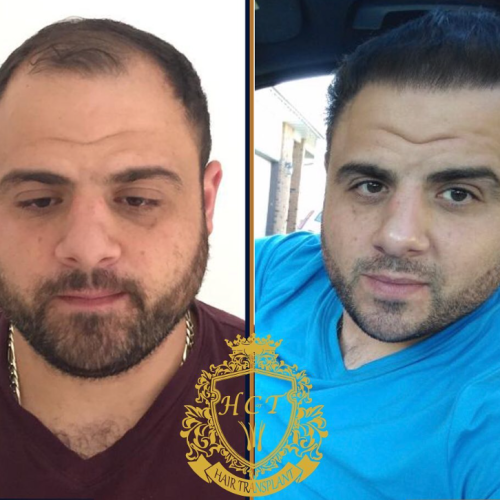 hair transplant before and after photos in turkey