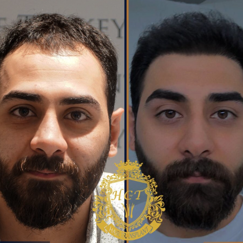 hair transplant before and after photos in turkey