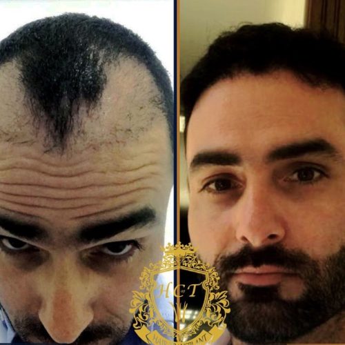 hair transplant before and after photos in turkey