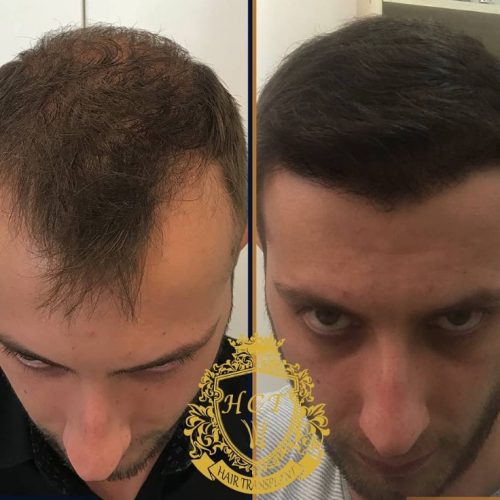 hair transplant before and after photos in turkey