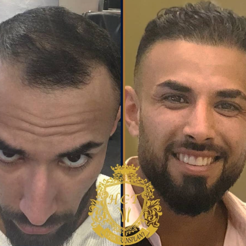 hair transplant before and after photos in turkey