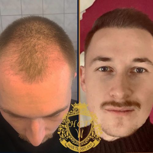 hair transplant before and after photos in turkey