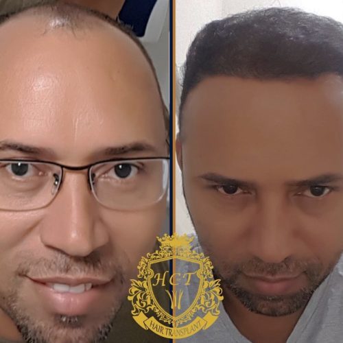 hair transplant before and after photos in turkey