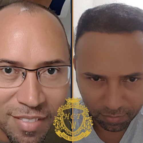 hair transplant before and after photos in turkey