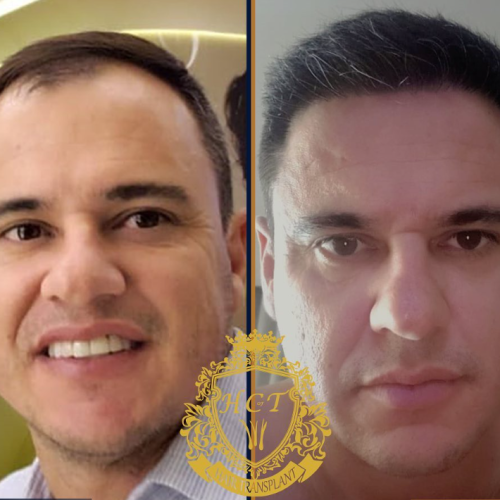 hair transplant before and after photos in turkey