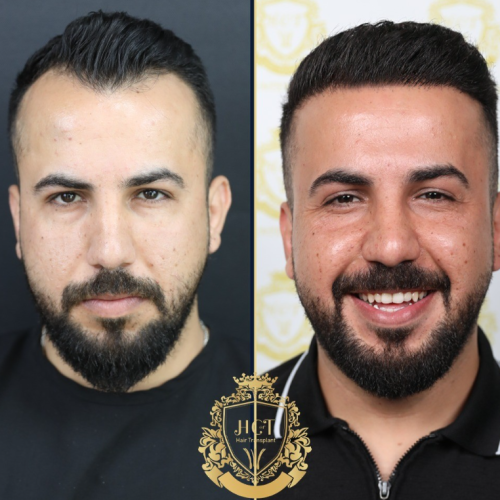 hair transplant before and after photos in turkey