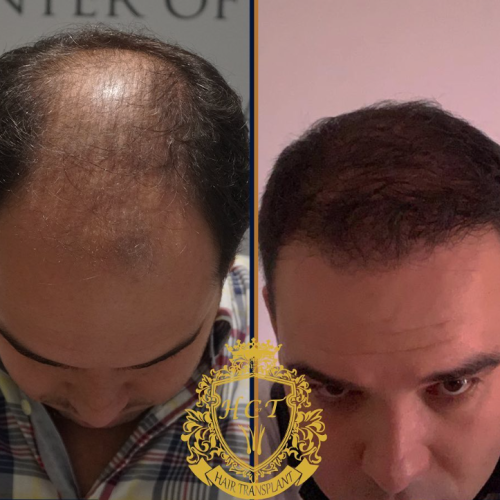 hair transplant before and after photos in turkey