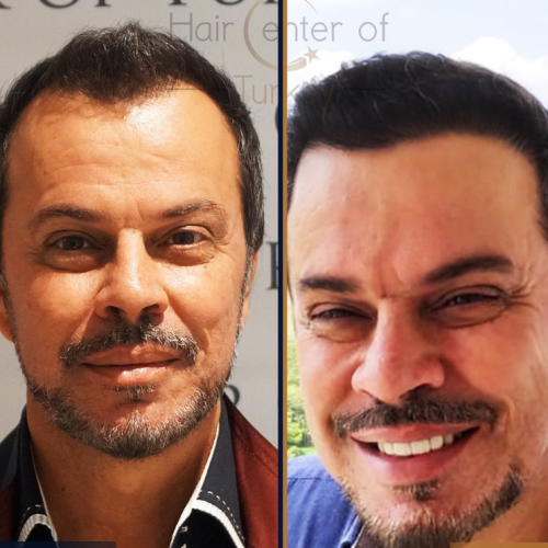 hair transplant before and after photos in turkey