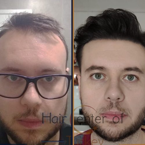 hair transplant before and after photos in turkey