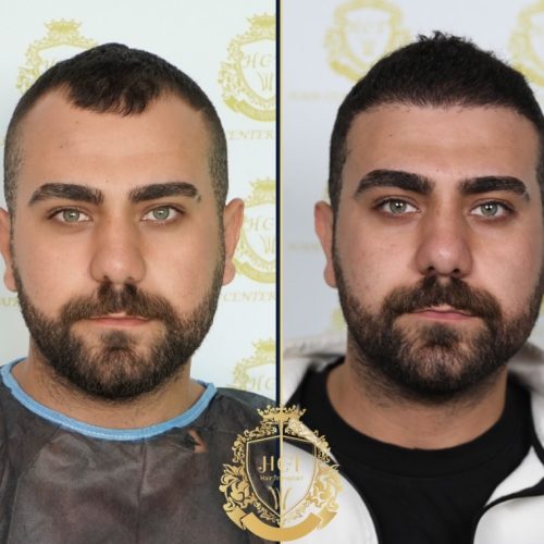 hair transplant before and after photos in turkey