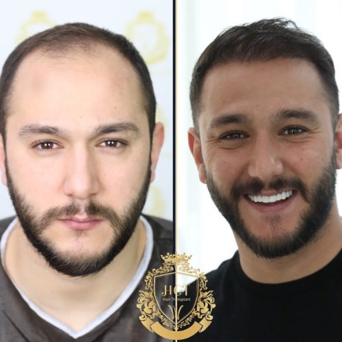 hair transplant before and after photos in turkey